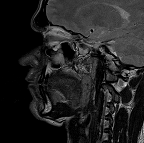 MRI face sagittal T2 images  