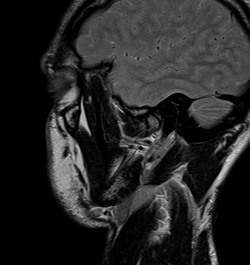 MRI face sagittal T2 images  