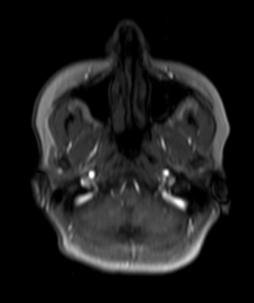 Malignant otitis externa (MOE) stir axial image 5