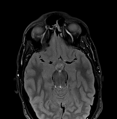 MRI face STIR axial images  