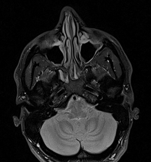 MRI face STIR axial images  