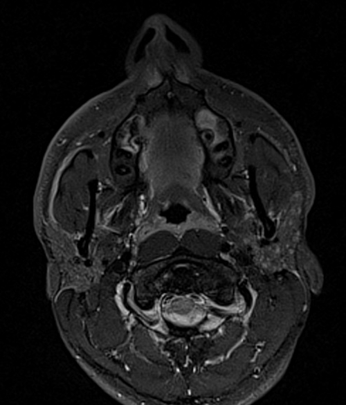 MRI face STIR axial images 