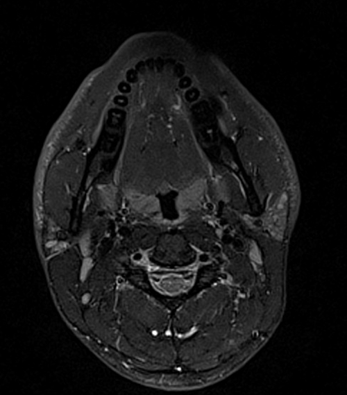 MRI face STIR axial images 