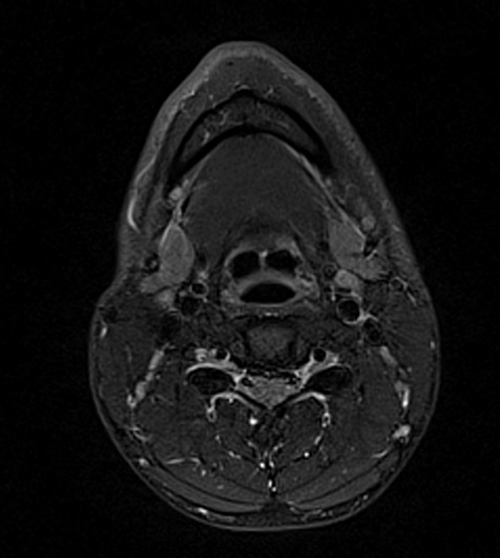 MRI face STIR axial images 