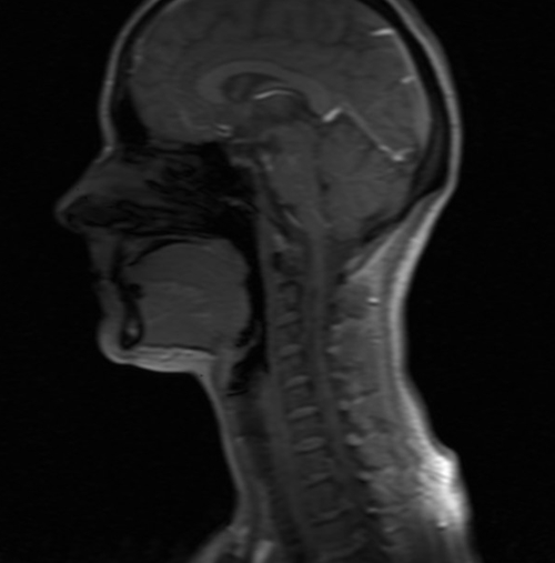 Malignant otitis externa (MOE) stir axial image 5