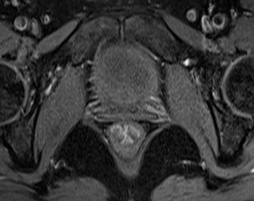 MRI female urethra axial oblique T1 fat sat high resolution images 