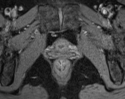 MRI female urethra axial oblique T1 fat sat high resolution images