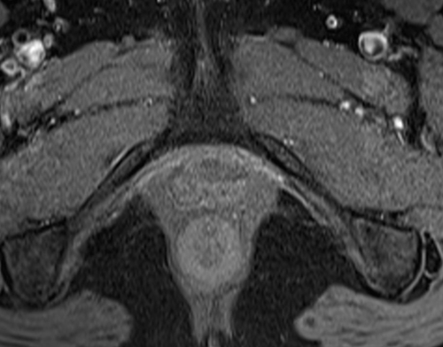 MRI female urethra axial oblique T1 fat sat high resolution images 