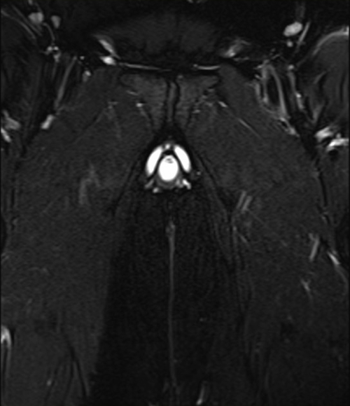 mri pelvis fistula coronal oblique  stir  image