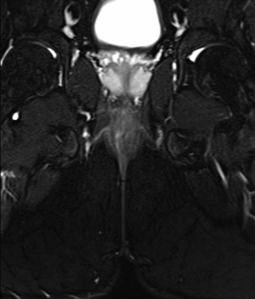 mri pelvis fistula coronal oblique  stir  image