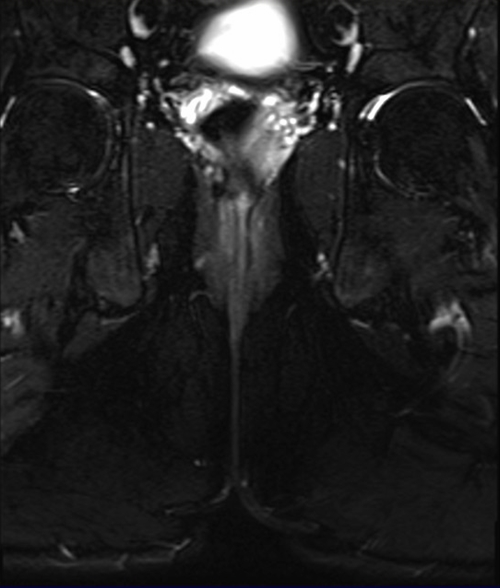 mri pelvis fistula coronal oblique  stir  image