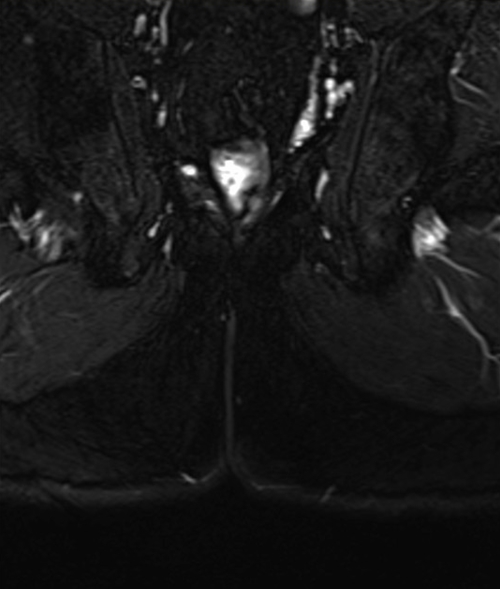 mri pelvis fistula coronal oblique  stir  image