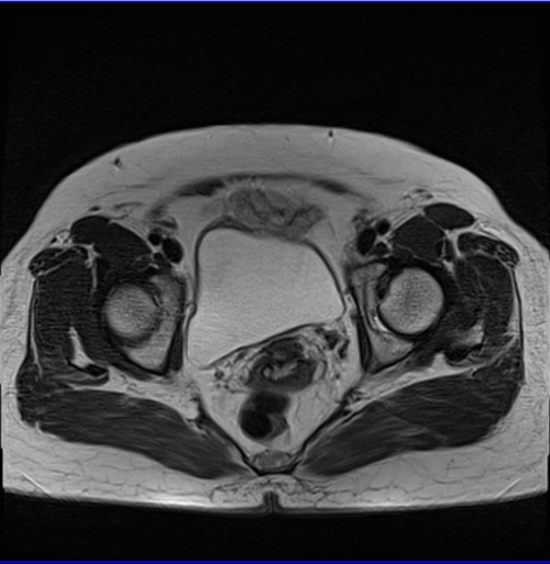 MRI female pelvis (gynaecology pelvis)  ca endometrium axial big fov t2