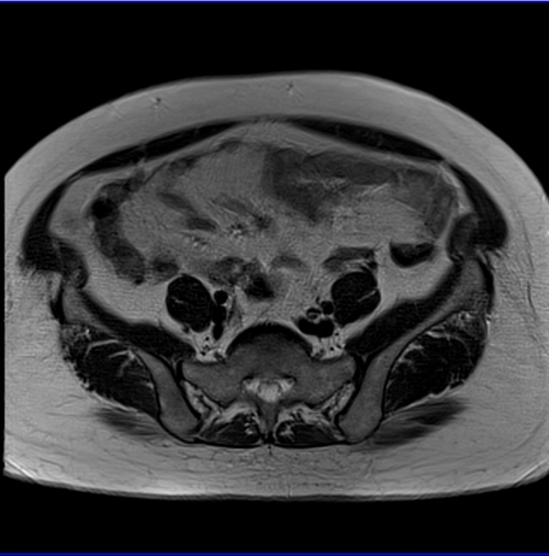 MRI female pelvis (gynaecology pelvis)  ca endometrium axial big fov t2