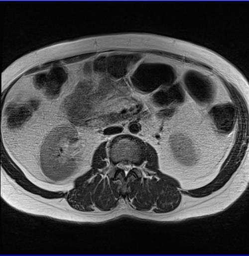 MRI female pelvis (gynaecology pelvis)  ca endometrium axial big fov t2