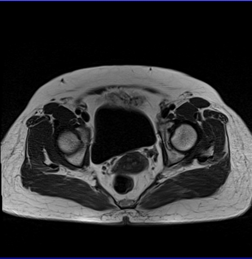 gyne pelvis ca endometrium axial