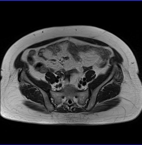 gyne pelvis ca endometrium axial