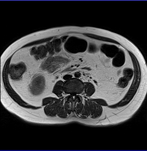 gyne pelvis ca endometrium axial