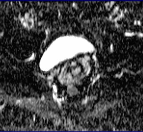 MRI female pelvis (gynaecology pelvis)  ca endometrium axial dwi adc