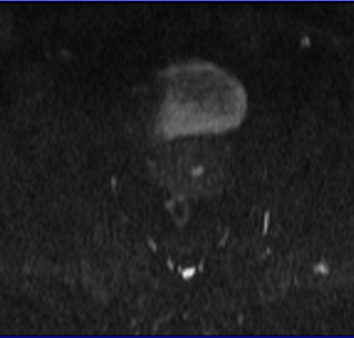 MRI female pelvis (gynaecology pelvis)  ca endometrium axial dwi b500