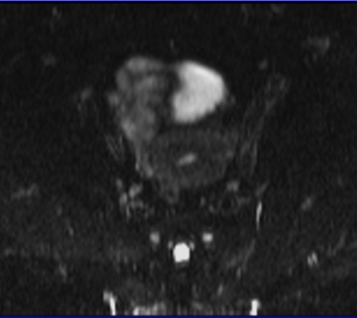 MRI female pelvis (gynaecology pelvis)  ca endometrium axial dwi bo