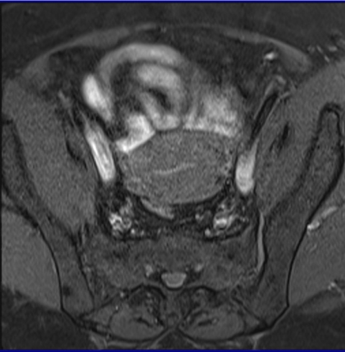 MRI female pelvis (gynaecology pelvis)  ca endometrium axial sfov t1 fat saturated image