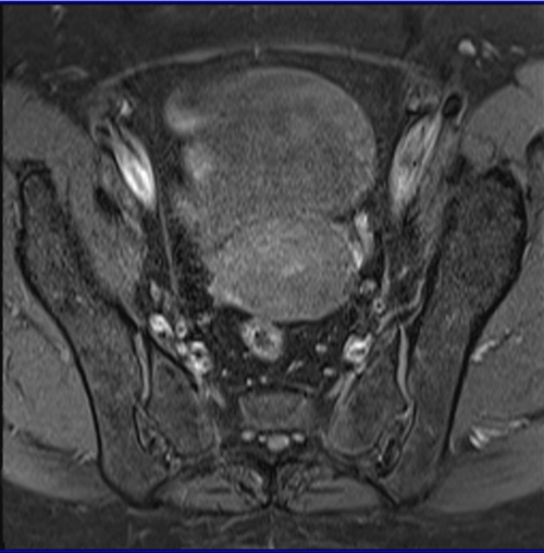 MRI female pelvis (gynaecology pelvis)  ca endometrium axial sfov t1 fat saturated image