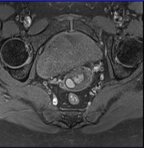 MRI female pelvis (gynaecology pelvis)  ca endometrium axial sfov t1 fat saturated image