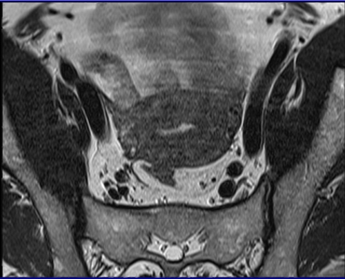 MRI female pelvis (gynaecology pelvis)  ca endometrium axial sfov t2