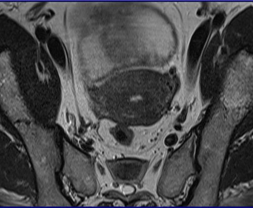 MRI female pelvis (gynaecology pelvis)  ca endometrium axial sfov t2