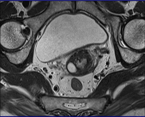 MRI female pelvis (gynaecology pelvis) ca endometrium axial sfov t2