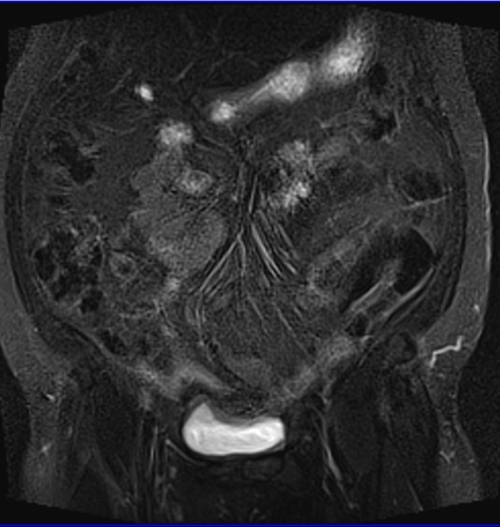 gyne pelvis ca endometrium coronal big fov stir