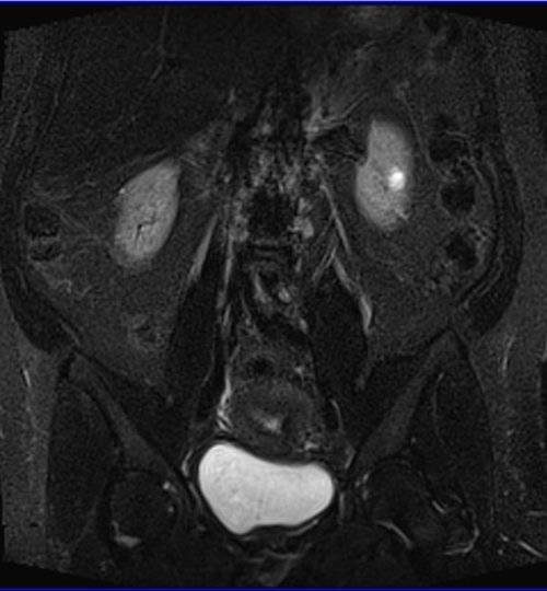 mri female pelvis ca endometrium coronal big fov stir