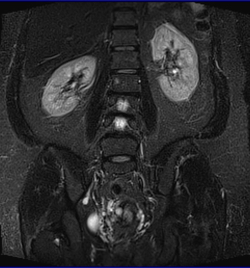 gyne pelvis ca endometrium coronal big fov stir