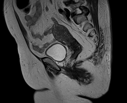 MRI female pelvis (gynaecology pelvis)  ca endometrium t2 sfov sag image