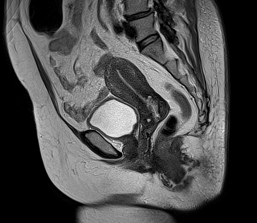 MRI female pelvis (gynaecology pelvis)  ca endometrium t2 sfov sag image