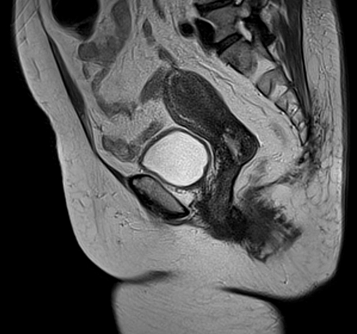 MRI female pelvis (gynaecology pelvis)  ca endometrium t2 sfov sag image