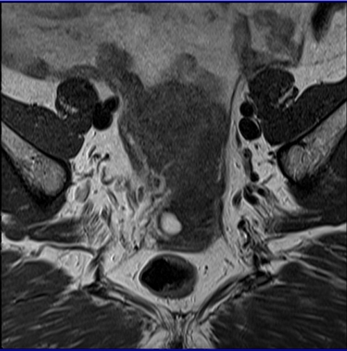 gyne pelvis ca endometriumcoronal sfov t2 