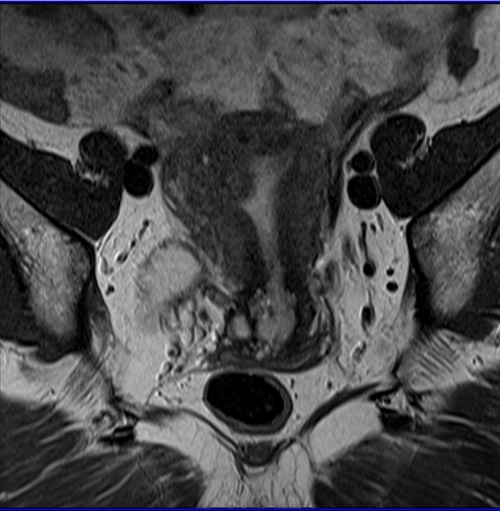 MRI female pelvis (gynaecology pelvis)  ca endometriumcoronal sfov t2 