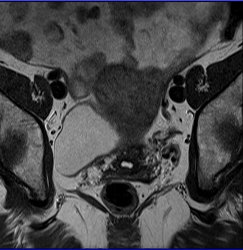 MRI female pelvis (gynaecology pelvis)  ca endometriumcoronal sfov t2 