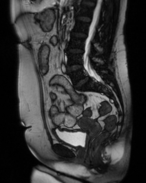 gyne pelvis ca endometrium coronal big fov stir