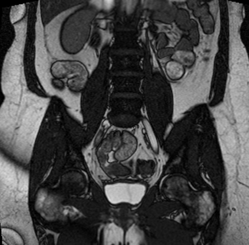 gyne pelvis ca endometrium coronal big fov stir