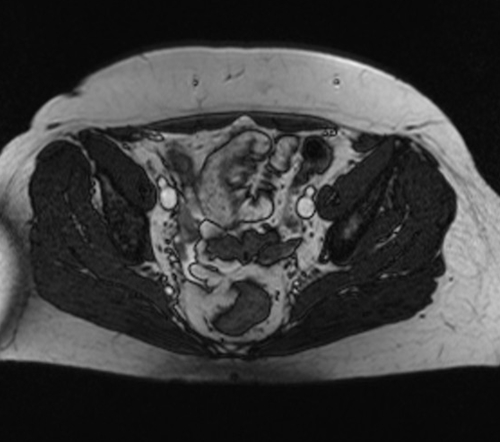 gyne pelvis ca endometrium coronal big fov stir