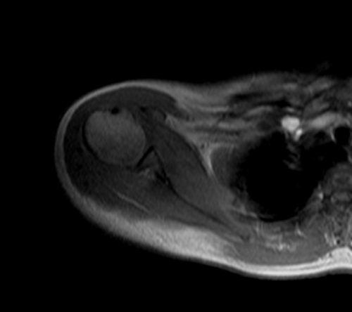 MRI humerus (upper arm)  localizer image