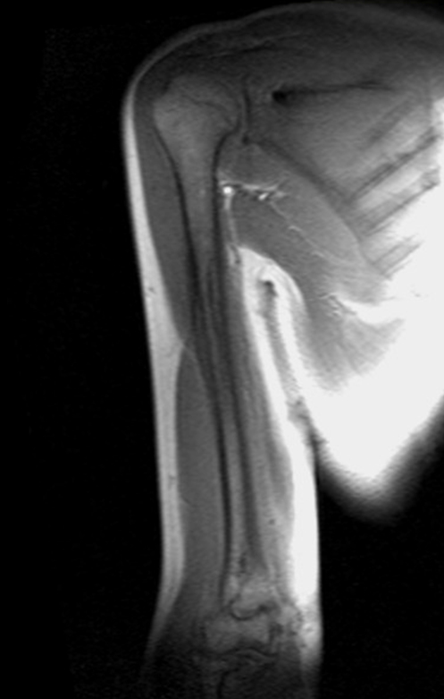 MRI humerus (upper arm)  localizer image