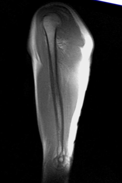 MRI humerus (upper arm)  localizer image