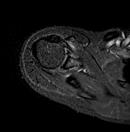 MRI humerus (upper arm) axial stir images