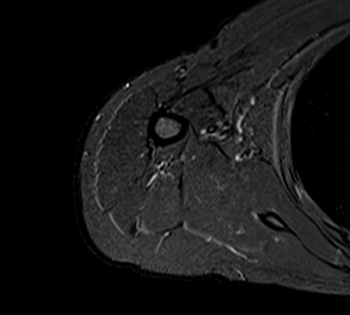 MRI humerus (upper arm) axial stir images