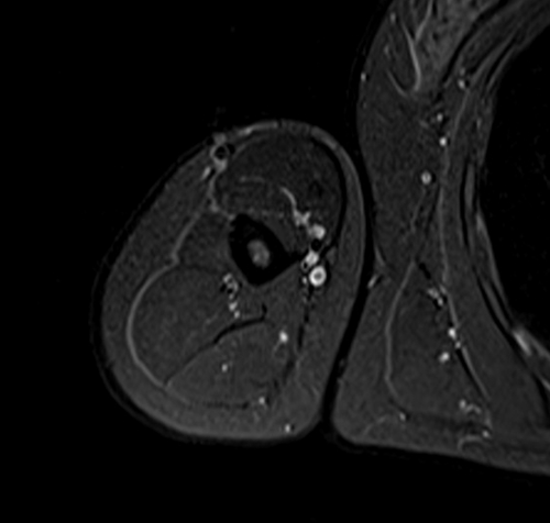 MRI humerus (upper arm) axial stir images