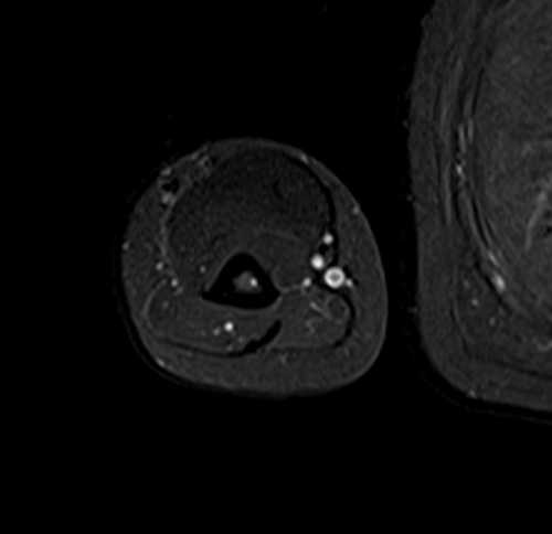 MRI humerus (upper arm) axial stir images